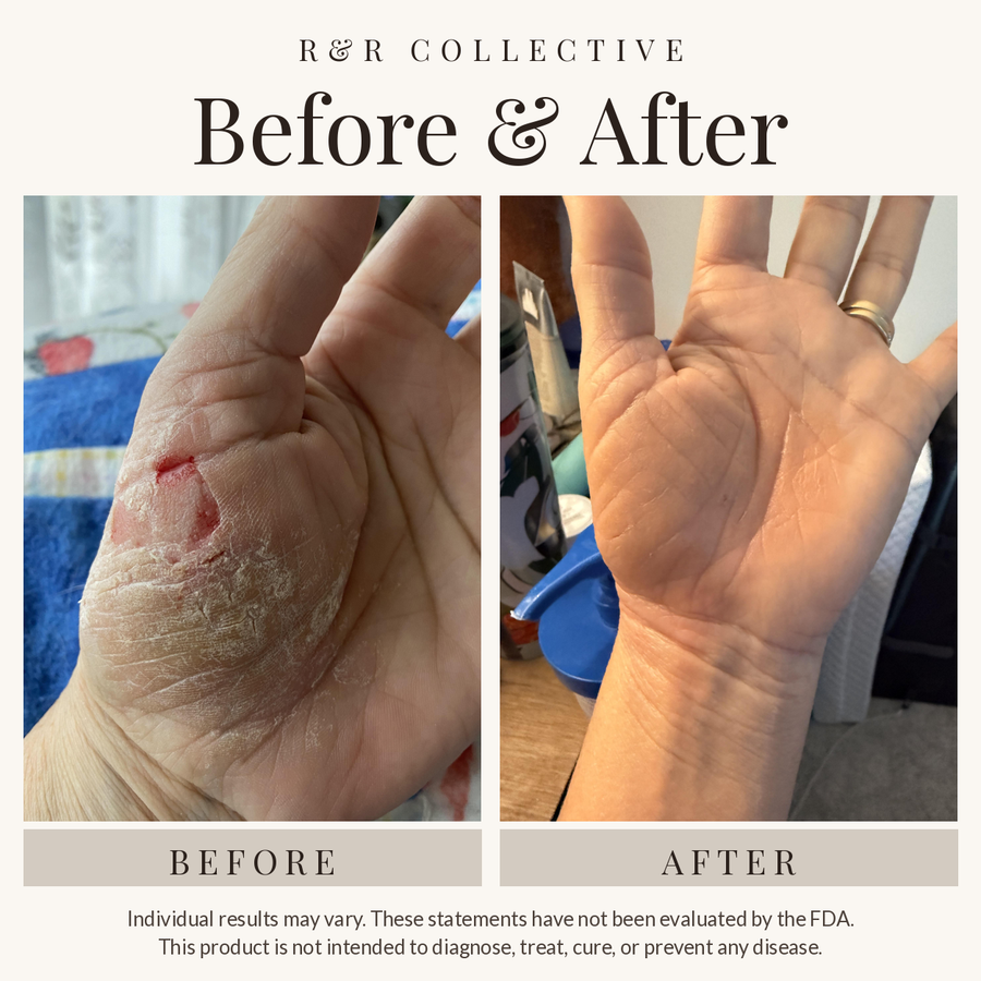 Customer before and after photo of dry, cracked hands